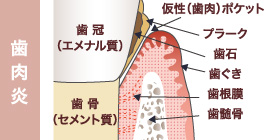 歯 肉 炎